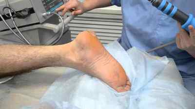 Лікування пяткової шпори лазером: відгуки, операція з видалення хірургічним шляхом, як виглядає шпора на нозі, як лікувати | Ревматолог