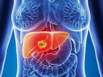 Лікування раку печінки народними засобами: рецепти і думка лікарів
