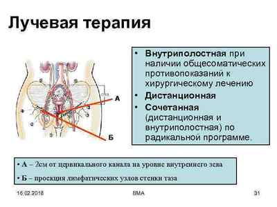 Лікування раку шийки матки методом променевої терапії: суть методики, наслідки