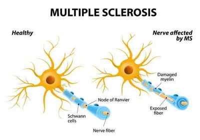 Лікування розсіяного склерозу стовбуровими клітинами