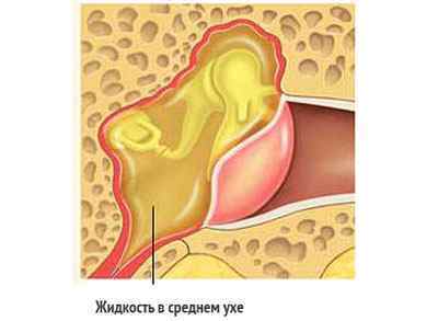 Лікування шуму у вухах при остеохондрозі шийного відділу
