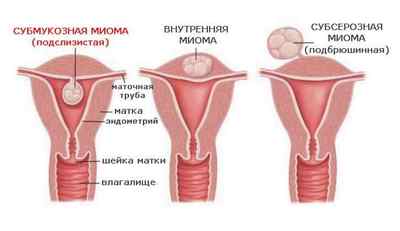 Лікування субмукозной міоми матки