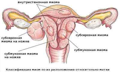 Лікування субсерозной міоми матки