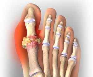 Лікування суглобів імбиром: при подагрі і артриті, рецепт, як використовувати імбир, лікування коренем імбиру артрозу колінного суглоба | Ревматолог