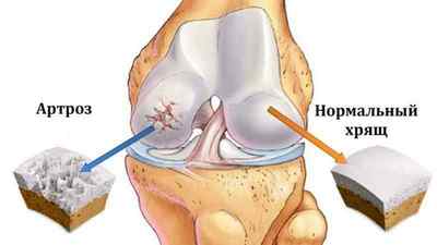 Лікування суглобів імбиром: при подагрі і артриті, рецепт, як використовувати імбир, лікування коренем імбиру артрозу колінного суглоба | Ревматолог