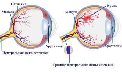 Лікування тромбозу центральної вени сітківки ока