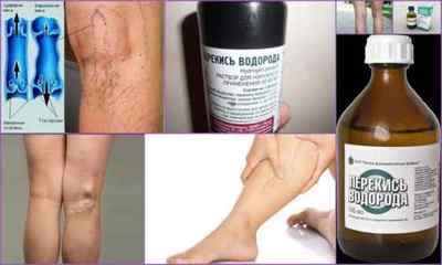 Лікування варикозного розширення вен на ногах по Неумивакіна перекисом і содою