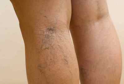 Лікування варикозної сітки і зірочок на ногах