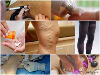 Лікування варикозу вен на ногах - сучасні методи і народні рецепти, відгуки пацієнтів