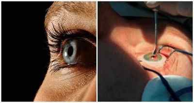 Лікування відшарування сітківки ока, як лікувати розшарування народними засобами