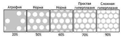 Лікування залозистої гіперплазії ендометрія