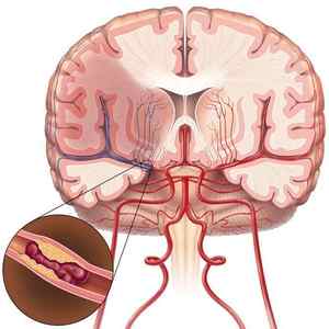 Лікування звуження судин головного мозку і причини прихованих симптомів