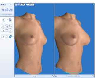 Ліпофілінг грудних залоз (грудей): плюси і мінуси, хід, результат