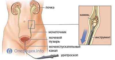 Літотрипсія, дроблення каменів в нирках: ультразвуком, лазером