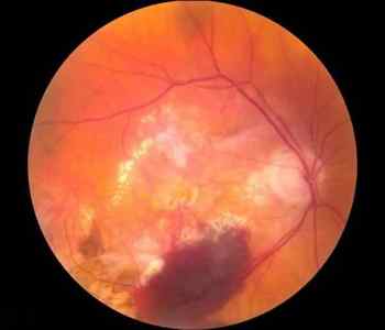Макулодістофія сітківки ока: лікування народними засобами, види (волога, суха, вікова)