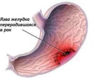 Малигнизация виразки шлунка: причини і механізм розвитку, симптоми, лікування