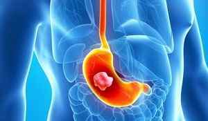 Малигнизация виразки шлунка: причини і механізм розвитку, симптоми, лікування