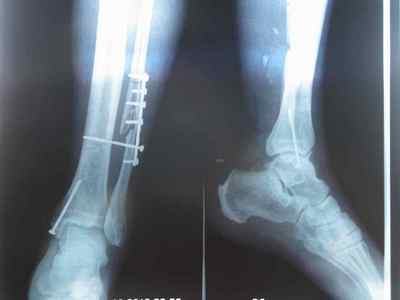 Малогомілкова кістка: анатомія, види переломів і їх лікування