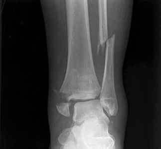 Малогомілкова кістка: анатомія, види переломів і їх лікування