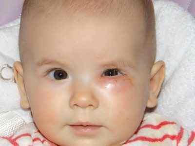 Масаж очного каналу у новонародженого: відео, як правильно робити