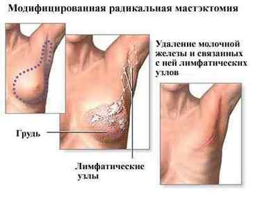 Мастектомія - операція з видалення молочної залози, грудей