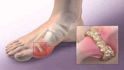Мазі і гелі для лікування артрозу колінного суглоба: знеболюючі і зігріваючі крему з назвами | Ревматолог