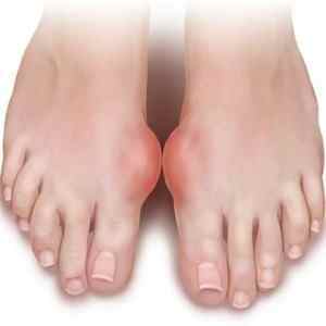 Мазі при подагрі: лікування подагри на ногах в період загострення, застосування мазі Вишневського, ефективні мазі | Ревматолог