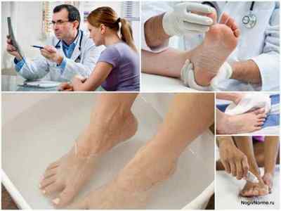 Мазь Тридерм для лікування грибка стопи і нігтів нігтів на ногах: інструкція, відгуки, аналоги