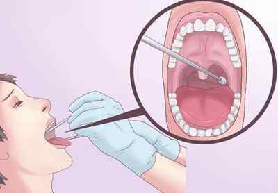 Мазок на дифтерію із горла і носа: як здавати, скільки робиться