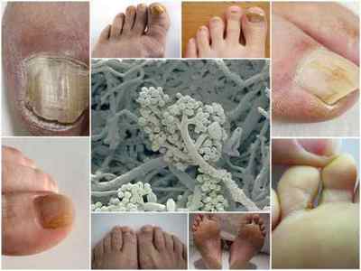 Міцелій грибка на нігтях і шкірі ніг: ознаки і лікування