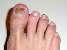 Міцелій грибка на нігтях і шкірі ніг: ознаки і лікування