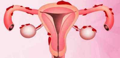 Механізм розвитку ендометріозу тіла матки