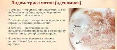 Механізм розвитку ендометріозу тіла матки