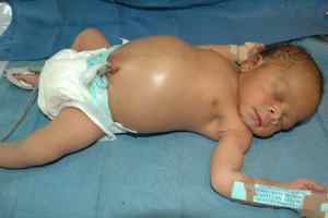 Меконій у новонароджених: час виходу, норма і патологія