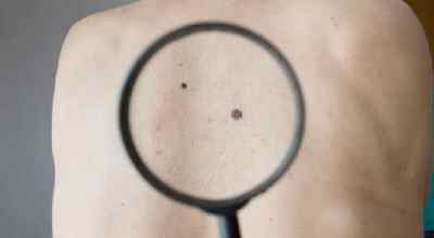 Меланома шкіри спини у чоловіків і жінок: стадії і лікування