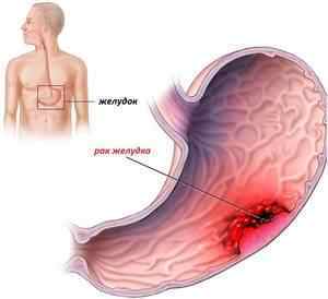 Метастази при раку шлунка: що це таке, симптоми, діагностика, прогноз
