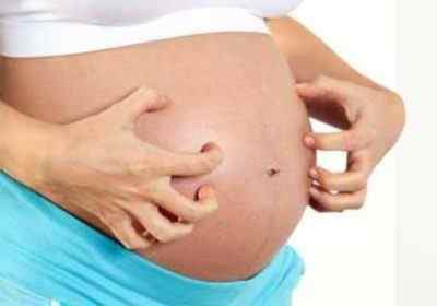 Методи лікування псоріазу при вагітності і небезпечно захворювання для плоду, а так само чим може загрожувати загострення?
