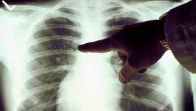 Методи лікування туберкульозу легенів у дорослих