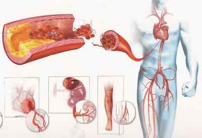 Методи профілактики ішемічної хвороби серця