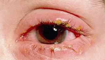 Метронідазол краплі очні: застосування розчину і лікування