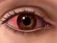 Мейбоміт нижнього або верхнього століття: лікування, симптоми мейбомиевой блефарити очей