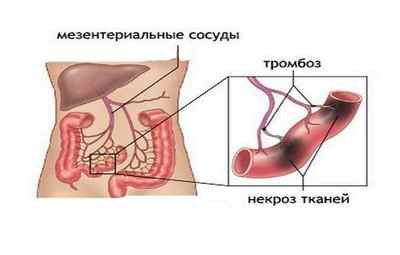 Мезентеріальний тромбоз судин і артерії кишечника
