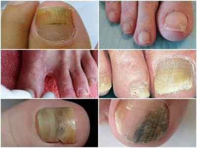 Мікоз нігтів на ногах - симптоми і лікування