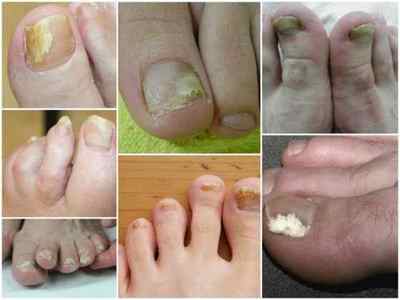 Мікоз нігтів на ногах - симптоми і лікування