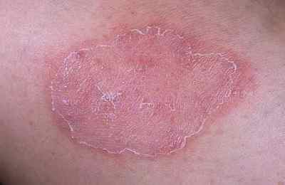 Мікоз шкіри: види, симптоми і лікування грибкових захворювань