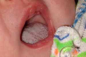 Молочниця в роті у немовляти: симптоми і лікування