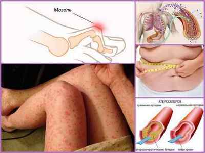 Молоткообразние пальці на ногах: фото, причини, консервативне лікування і операція