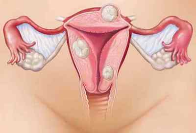 Міома матки - Ознаки, симптоми, способи лікування і профілактика