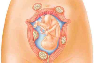 Міома матки - Ознаки, симптоми, способи лікування і профілактика
