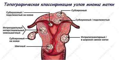 Міома матки: фото, причини, лікування, симптоми